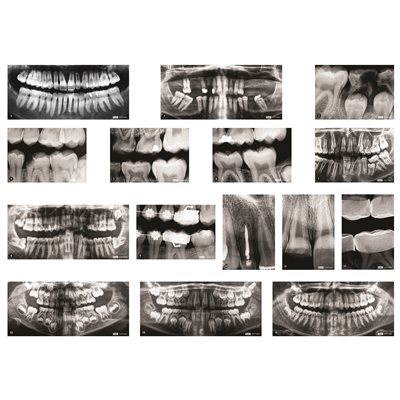 Dental X-Rays- Pack of 10 